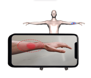 Übertragung einer Brandwunde von einem 2D Bild auf ein 3D Patient*innen-Modell. Die automatische Wundlokalisation und Anpassung des 3D Modells an die Körperform desder Patient*in ermöglicht eine objektivere Bestimmung der Wundgröße und Dokumentation des Heilungsverlaufs.